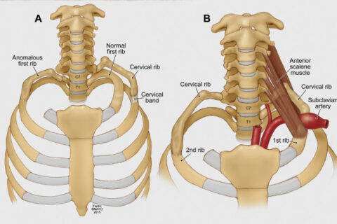 Cervical Rib