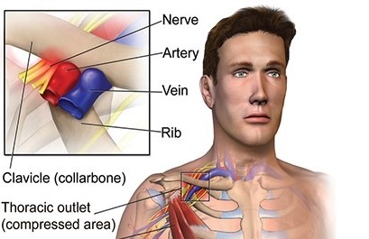 Thoracic Outlet Syndrome